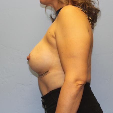 After image 3 Case #131716 - Breast Augmentation Rao Plastic Surgery Tucson, AZ