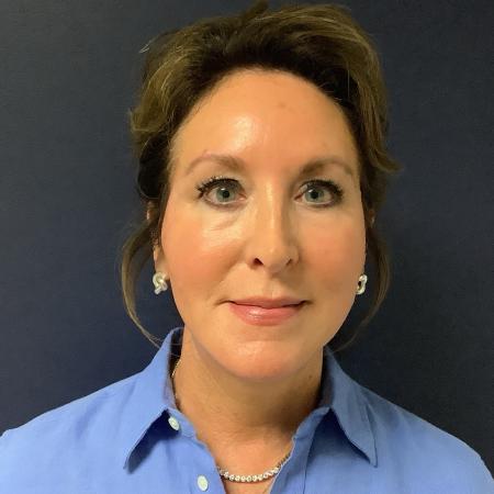 After image 1 Case #133146 - SMAS Facelift 