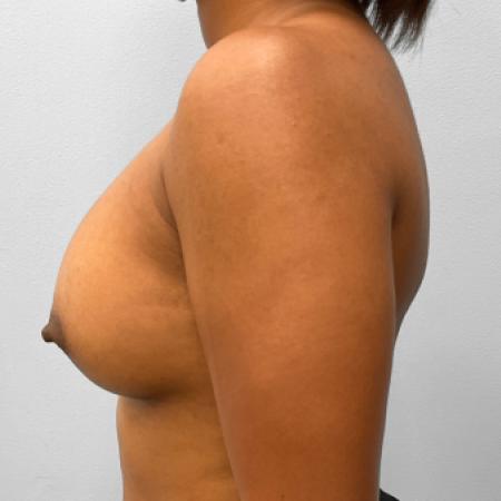 After image 3 Case #132796 - Breast Augmentation