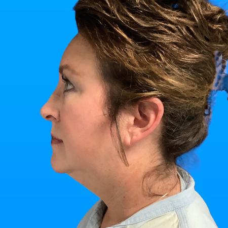 Before image 2 Case #133146 - SMAS Facelift 