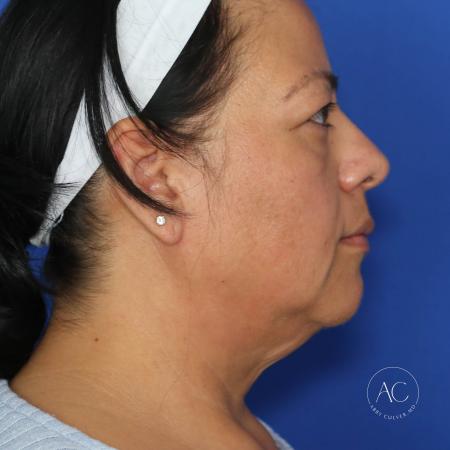 Before image 3 Case #132266 - Face and necklift with upper/lower blepharoplasty 