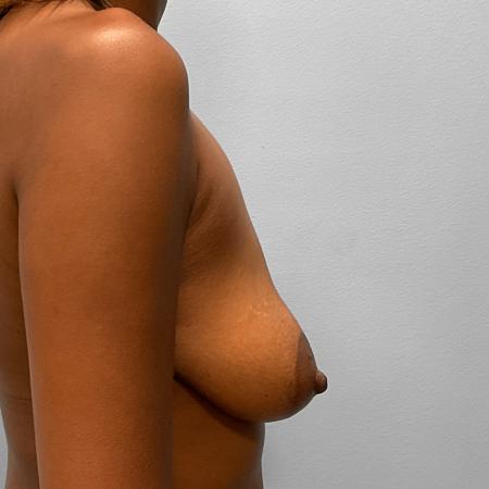 Before image 3 Case #132786 - Breast Augmentation & Lift