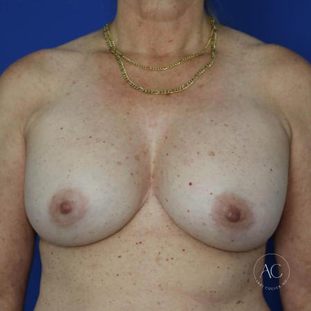 After image 1 Case #133131 - Breast implant exchange