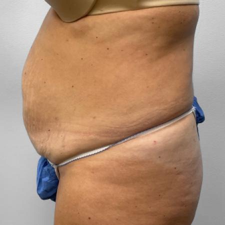 Before image 3 Case #132801 - Tummy Tuck
