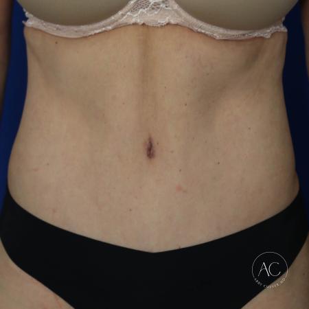 After image 1 Case #132216 - Abdominoplasty with liposuction