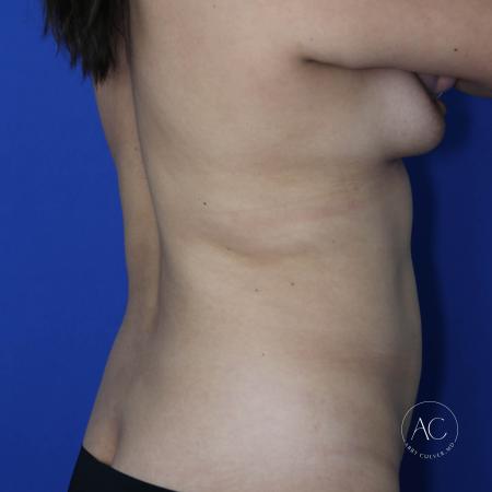 Before image 4 Case #133136 - Breast lift with implants and lipoabdominoplasty