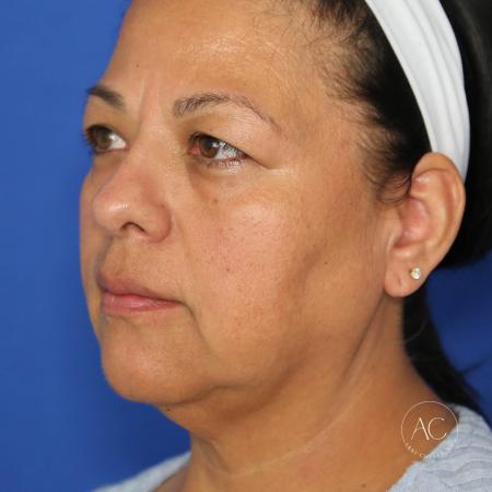 Before image 2 Case #132266 - Face and necklift with upper/lower blepharoplasty 