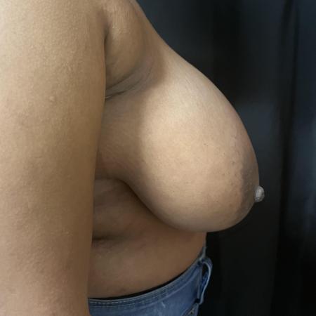 Before image 3 Case #133231 - Medial Pedicle Reduction Mammoplasty