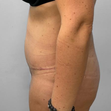 After image 3 Case #132801 - Tummy Tuck
