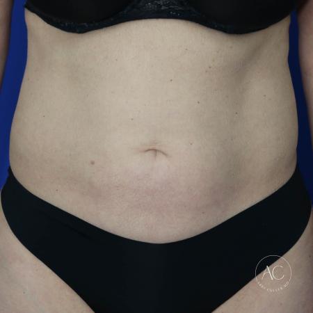 Before image 1 Case #132216 - Abdominoplasty with liposuction