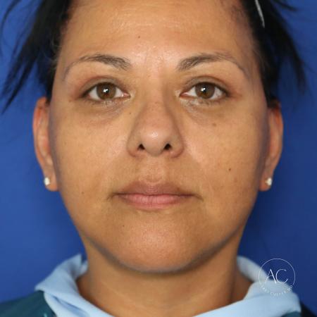 Before image 1 Case #132266 - Face and necklift with upper/lower blepharoplasty 