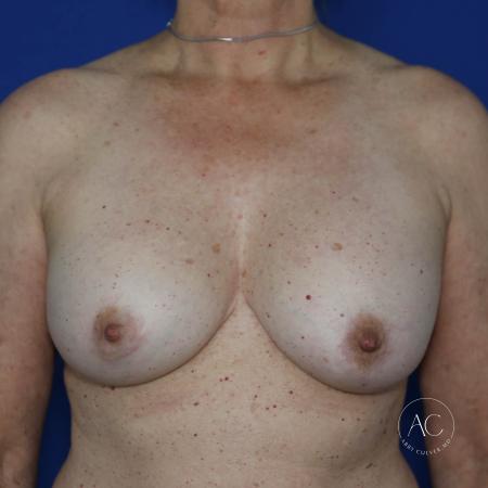 Before image 1 Case #133131 - Breast implant exchange