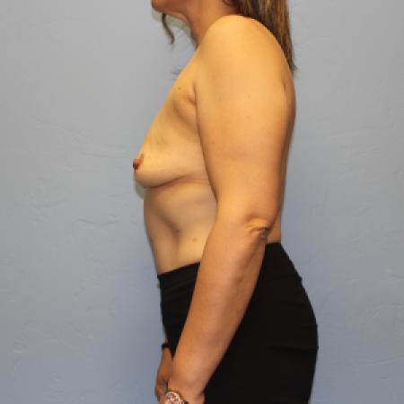 Before image 3 Case #131716 - Breast Augmentation Rao Plastic Surgery Tucson, AZ