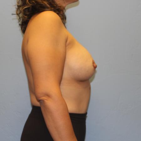 After image 5 Case #131716 - Breast Augmentation Rao Plastic Surgery Tucson, AZ