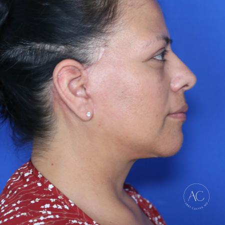 After image 3 Case #132266 - Face and necklift with upper/lower blepharoplasty 