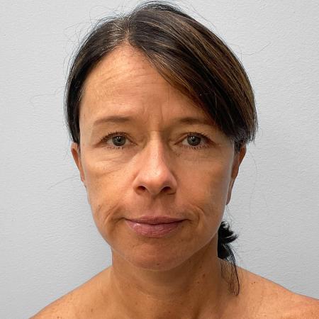 After image 1 Case #133111 - Facelift & Laser Resurfacing