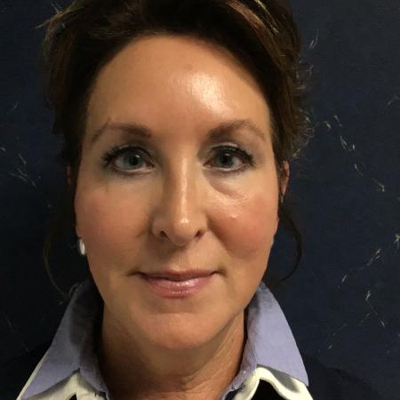 Before image 1 Case #133146 - SMAS Facelift 