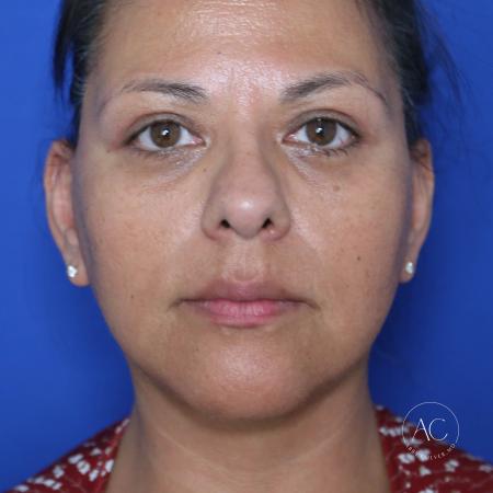 After image 1 Case #132266 - Face and necklift with upper/lower blepharoplasty 