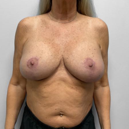 After image 1 Case #133121 - Breast Enhance