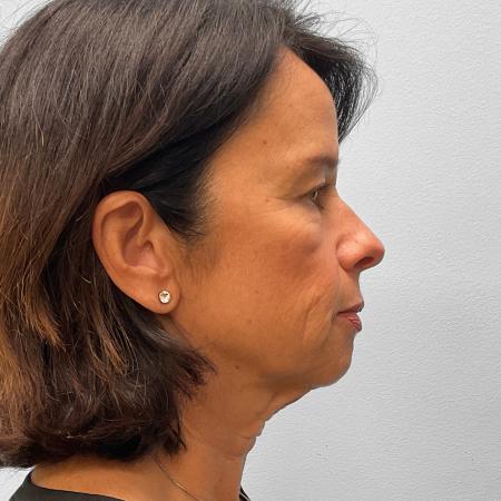 Before image 3 Case #133111 - Facelift & Laser Resurfacing