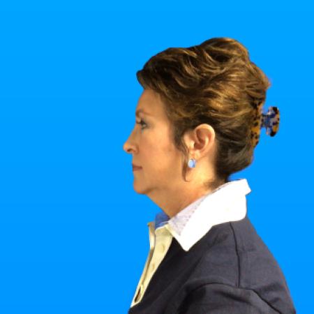 Before image 3 Case #133146 - SMAS Facelift 