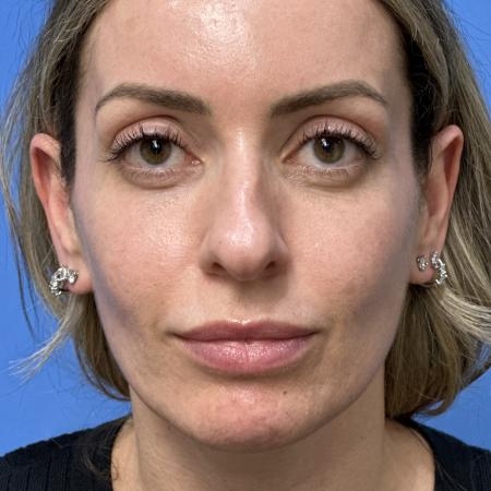 Before image 1 Case #133461 - 38 year old  -  Open Rhinoplasty  -  4 months post