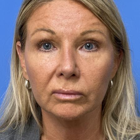 After image 1 Case #133356 - Rhinoplasry