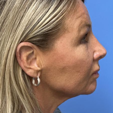 After image 3 Case #133356 - Rhinoplasry