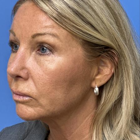 After image 2 Case #133356 - Rhinoplasry