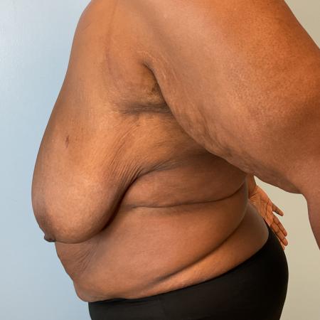 Before image 3 Case #133441 - 49 y.o. female w/ Breast Reduction & Tummy Tuck