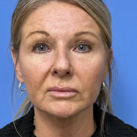 Before image 1 Case #133356 - Rhinoplasry
