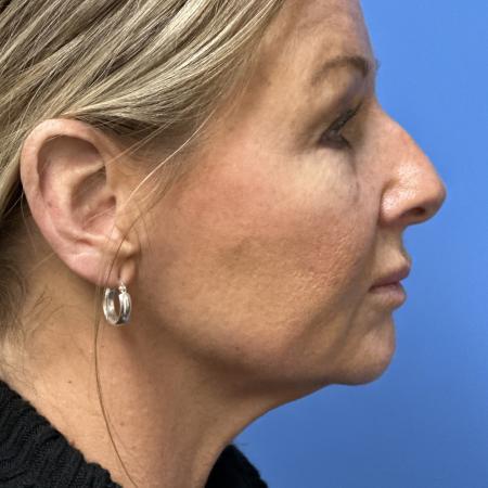 Before image 3 Case #133356 - Rhinoplasry