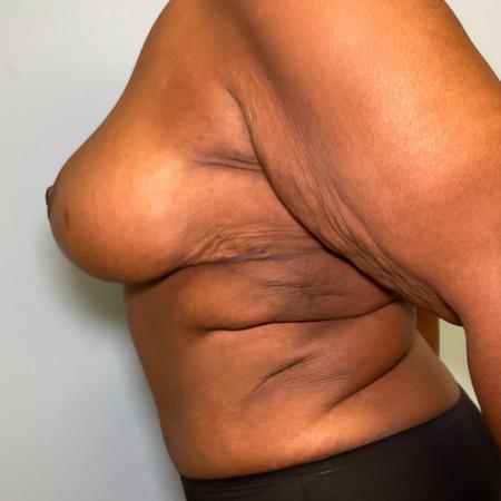 After image 3 Case #133441 - 49 y.o. female w/ Mommy Makeover