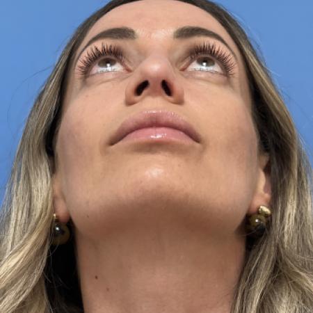 After image 4 Case #133461 - 38 year old  -  Open Rhinoplasty  -  4 months post