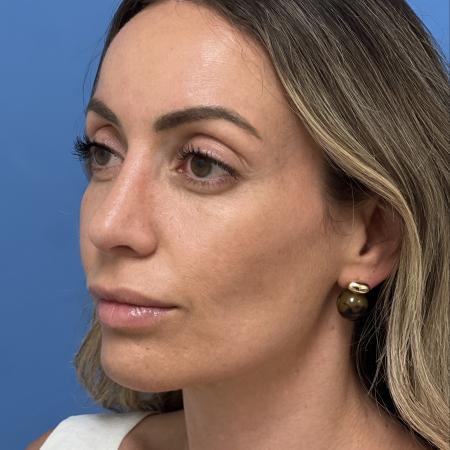 After image 2 Case #133461 - 38 year old  -  Open Rhinoplasty  -  4 months post