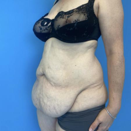 Before image 2 Case #134086 - Tummy Tuck