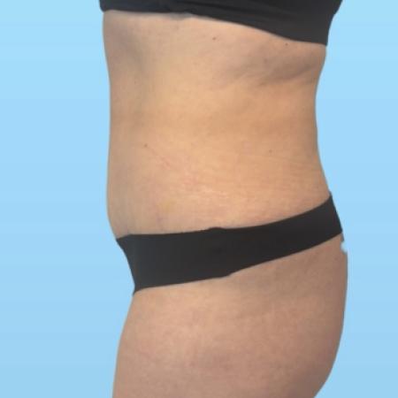 After image 3 Case #133996 - Tummy tuck