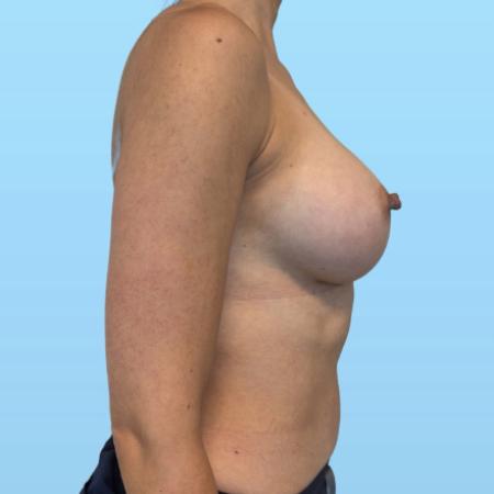 After image 3 Case #134016 - Breast Augmentation