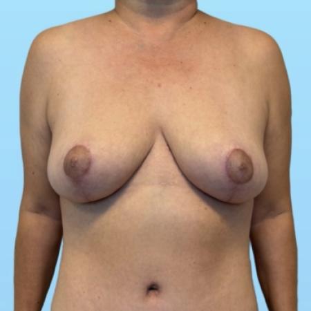 After image 1 Case #134006 - Mommy Makeover