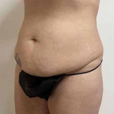 Before image 2 Case #133996 - Tummy tuck