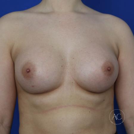 After image 1 Case #133746 - Breast augmentation 