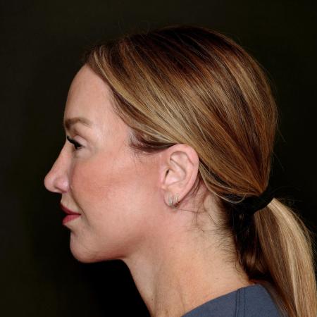 After image 3 Case #133616 - Deep Plane Face Lift