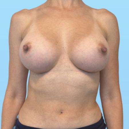 After image 1 Case #134016 - Breast Augmentation