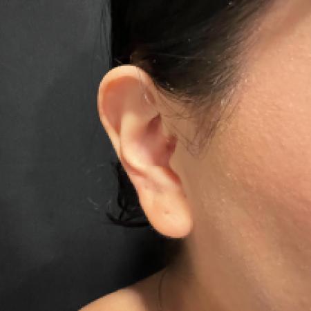 After image 1 Case #133661 - Bilateral Otoplasty