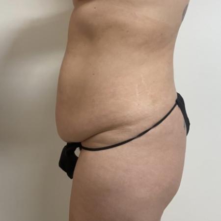 Before image 3 Case #133996 - Tummy tuck