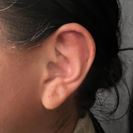 After image 2 Case #133661 - Bilateral Otoplasty
