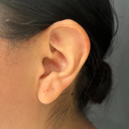 Before image 2 Case #133661 - Bilateral Otoplasty