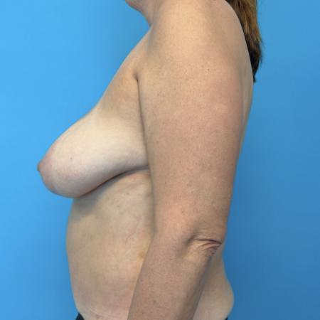 Before image 2 Case #134026 - Breast Reduction