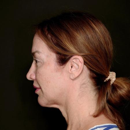 Before image 3 Case #133616 - Deep Plane Face Lift