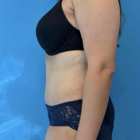 After image 2 Case #134011 - Tummy Tuck